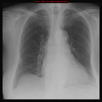 Dissection aortique et tamponnade post-TAVI (Transcatheter Aortic Valve Implantation) Radiographie Thorax avant TAVI Dissection aortique et tamponnade post-TAVI (Transcatheter Aortic Valve Implantation) Radiographie Thorax avant TAVI