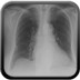 Dissection aortique et tamponnade post-TAVI (Transcatheter Aortic Valve Implantation)  Radiographie Thorax avant TAVI