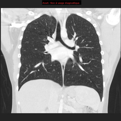 Hereditary hemorrhagic telangiectasia with lung arteriovenous malformation  CT Thorax Coronal