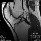 Fracture tassement du plateau tibial latéral SAG T1 Fracture tassement du plateau tibial latéral SAG T1