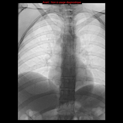 Repéchage de corps étranger par lasso  Radiographie Thorax Controle