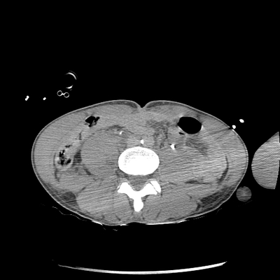 Severe cranioencephalic injuries, Carotid artery dissection, Aspiration pneumonia, Pelvic fracture Abdomen CT, Delayed phase, Axial plane