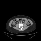 Appendagite TDM Abdomen Axial Fenêtre Tissus mous Appendagite TDM Abdomen Axial Fenêtre Tissus mous