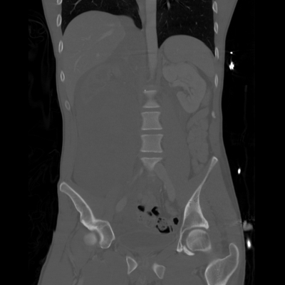 rupture de la veine rénale, hématome de la surrénale abdomen coro os