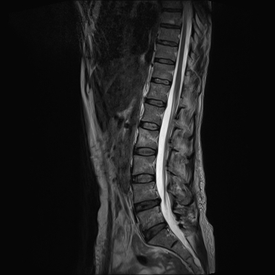 Traumatic perforation of small intestine, fracture of lumbar vertebra Lombar spine, T2 Sagittal plane