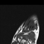 Syndrome du canal carpien de manière bilatérale sur dépots amyloides. IRM poignet droit coronal T1 sans injection Syndrome du canal carpien de manière bilatérale sur dépots amyloides. IRM poignet droit coronal T1 sans injection
