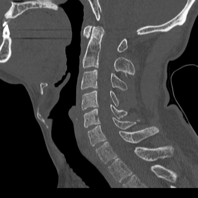 Thoracic Injuries, Spinal Injuries L5, Traumatic disc herniation Cervical spine, Sagittal plane, Bone window