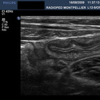 Iléite terminale infectieuse Echographie digestive, région iléo-caecale Iléite terminale infectieuse Echographie digestive, région iléo-caecale