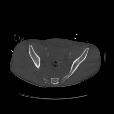 Severe cranioencephalic injuries, Carotid artery dissection, Aspiration pneumonia, Pelvic fracture Pelvic CT, Axial plane, Bone window