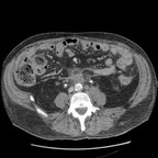 carcinose rétropéritonéale sur tumeur vésicale envahissant le 3ième duodénum. TDM Abdomen Pelvis Axial temps portal carcinose rétropéritonéale sur tumeur vésicale envahissant le 3ième duodénum. TDM Abdomen Pelvis Axial temps portal