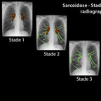 Sarcoïdose Sarcoïdose Stades sur la radiographie de thorax Sarcoïdose Sarcoïdose Stades sur la radiographie de thorax