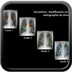 Sarcoïdose Sarcoïdose Stades sur la radiographie de thorax