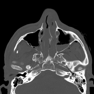 Severe cranioencephalic injuries, Carotid artery dissection, Aspiration pneumonia, Pelvic fracture Head CT, Axial plane, Bone window