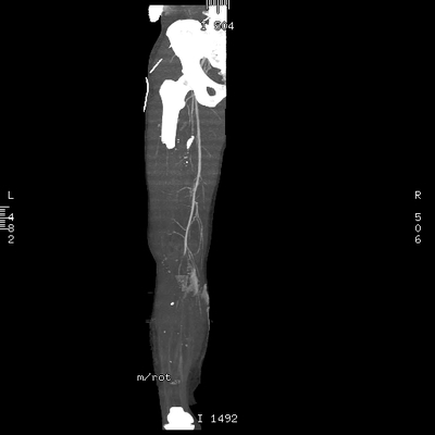 Cranioencephalic injuries, limb injuries, aspiration pneumonia VR MIP on right Lower limbs