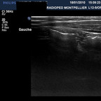 Colite infectieuse Tube digestif ( du caecum au sigmoïde) Colite infectieuse Tube digestif ( du caecum au sigmoïde)