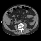 Hepatic fracture, Active hemorrhage Abdomen CT without inj Hepatic fracture, Active hemorrhage Abdomen CT without inj