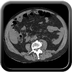 Hepatic fracture, Active hemorrhage Abdomen CT without inj