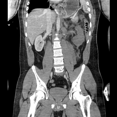 hernie diaphragmatique, traumatisme thoracique, traumatisme abdominal, burst fracture, fracture du pied abdomen portal coro