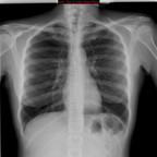 Adénocarcinome pulmonaire avec contingent à cellules claires Radiographie Thorax (1 an auparavant) Adénocarcinome pulmonaire avec contingent à cellules claires Radiographie Thorax (1 an auparavant)
