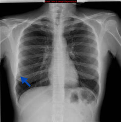 Adénocarcinome pulmonaire avec contingent à cellules claires Radiographie Thorax (1 an auparavant)