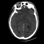 Cranioencephalic trauma, Facial fracture, Thoracic injuries, Pelvic fracture, Spleen and renal trauma Head CT, Axial plane, Soft tissue window Cranioencephalic trauma, Facial fracture, Thoracic injuries, Pelvic fracture, Spleen and renal trauma Head CT, Axial plane, Soft tissue window