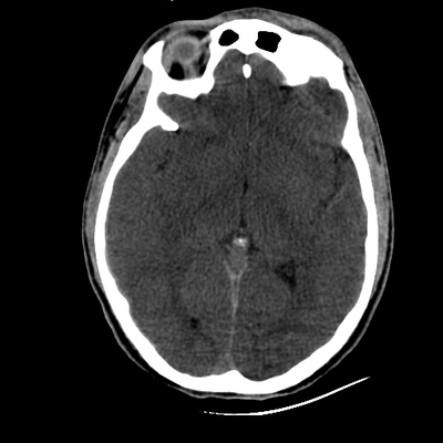 traumatisme cranien, fracture du massif facial, traumatisme thoracique, fracture pelvienne, traumatisme spléno-rénal crane axial mou
