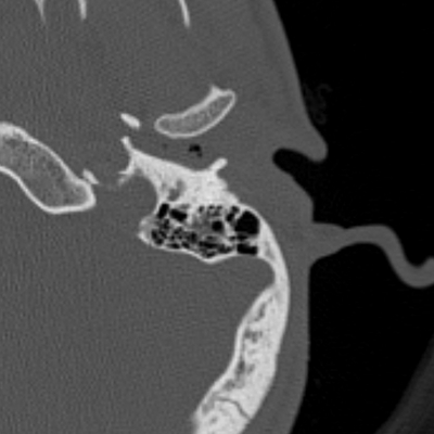 traumatisme cranien, oedème pulmonaire, lacération du rein rocher gauche ax os