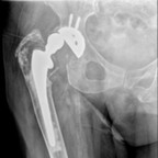 Descellement de l'implant fémoral sur réaction granulomateuse secondaire à une usure du polyéthylène Radiographie Descellement de l'implant fémoral sur réaction granulomateuse secondaire à une usure du polyéthylène Radiographie