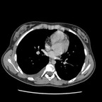 Sarcome d'Ewing costal TDM thorax Sarcome d'Ewing costal TDM thorax