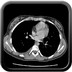 Sarcome d'Ewing costal TDM thorax