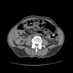 Erosion de l'artère splénique par un pseudo-kyste pancréatique Axial Sans injection Erosion de l'artère splénique par un pseudo-kyste pancréatique Axial Sans injection