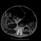 Volvulus du sigmoide organo axial TDM Abdomen pelvis Axial Temps veineux Volvulus du sigmoide organo axial TDM Abdomen pelvis Axial Temps veineux