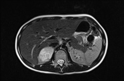 Phéochromocytome et paragangliome dans un contexte de maladie de Von Hippel Lindau ser007img00001