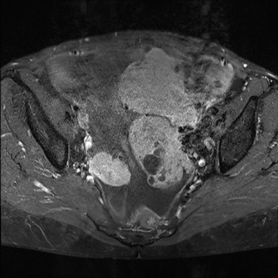 Cystadénocarcinome ovarien séro-papillaire moyennement différencié Stade IIIb Axial T1 Fat Sat