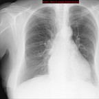 Pneumopathie interstitielle lymphocytaire (LIP) Radiographie Thorax Face Pneumopathie interstitielle lymphocytaire (LIP) Radiographie Thorax Face