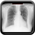  Pneumopathie interstitielle lymphocytaire (LIP)  Radiographie Thorax Face
