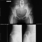 Chondrosarcome sur exostose ostéogénique Radiographie Pelvis Chondrosarcome sur exostose ostéogénique Radiographie Pelvis