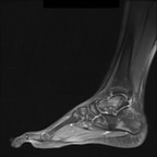 Maladie de Ledderhose/Fibromatose superficielle plantaire IRM Pied gauche sagittal DP FS Maladie de Ledderhose/Fibromatose superficielle plantaire IRM Pied gauche sagittal DP FS