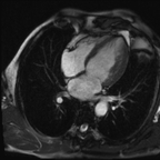 Non compaction du ventricule gauche Ciné-IRM 4 cavités Non compaction du ventricule gauche Ciné-IRM 4 cavités