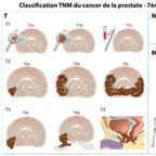 Cancer de la prostate TNM-staging-prostate-cancer-fr Cancer de la prostate TNM-staging-prostate-cancer-fr
