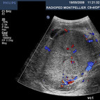 Néphroblastome droit Echographie abdo Néphroblastome droit Echographie abdo