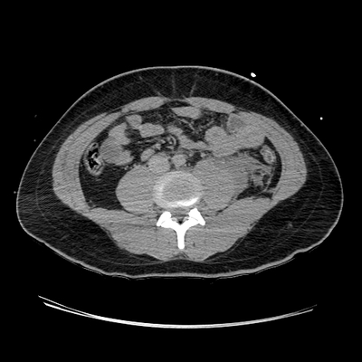 hernie diaphragmatique, traumatisme thoracique, traumatisme abdominal, burst fracture, fracture du pied abdomen tardif axial