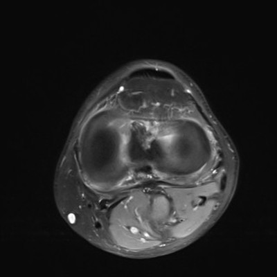 Anévrysme poplité thrombosé DP FS Axial