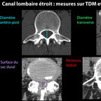 Canal lombaire étroit Lumbar-spinal-stenosis-canal-diameter-fr Canal lombaire étroit Lumbar-spinal-stenosis-canal-diameter-fr