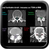 Canal lombaire étroit Lumbar-spinal-stenosis-canal-diameter-fr
