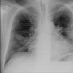 Atteinte pulmonaire d'une maladie de Wegener Thorax face Atteinte pulmonaire d'une maladie de Wegener Thorax face