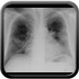 Atteinte pulmonaire d'une maladie de Wegener Thorax face