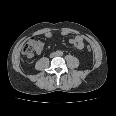 Kyste de la vésicule séminale et agénésie rénale homolatérale TDM Abdomen Pelvis Axial