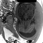 Kyste rétro cérébelleux associé à des hétérotopies périventriculaires IRM encéphalique axiale T1 Kyste rétro cérébelleux associé à des hétérotopies périventriculaires IRM encéphalique axiale T1