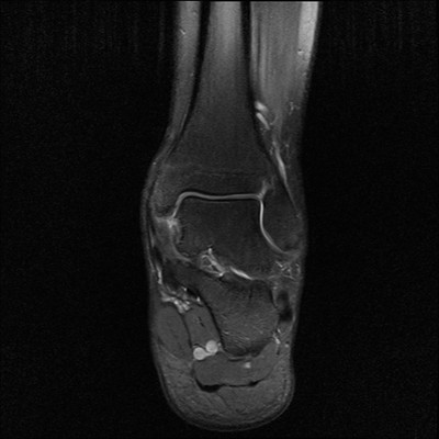 Séquelles post traumatiques du ligament collatéral latéral IRM DP fat sat Coronal